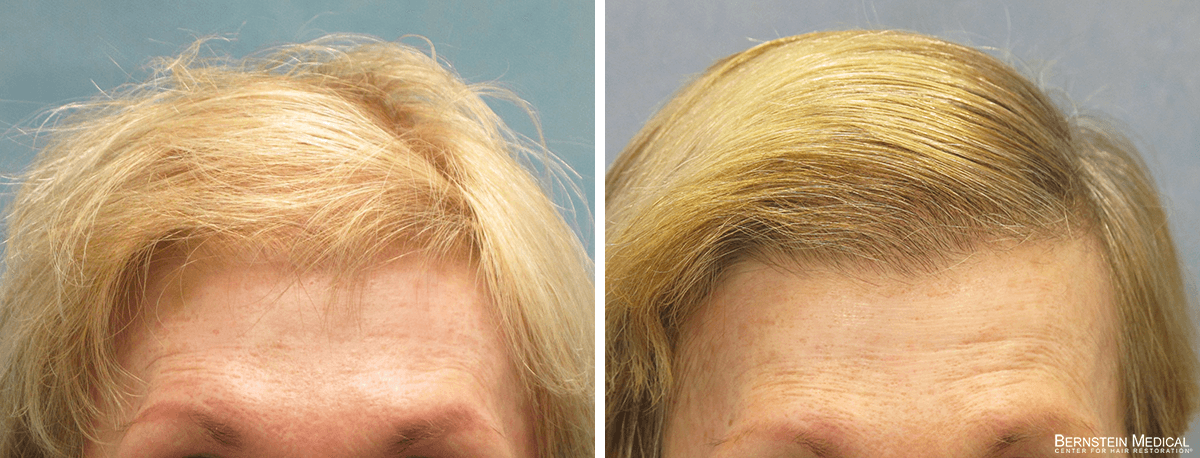 Bernstein Medical - Patient GTB Before and After Hair Transplant Photo 