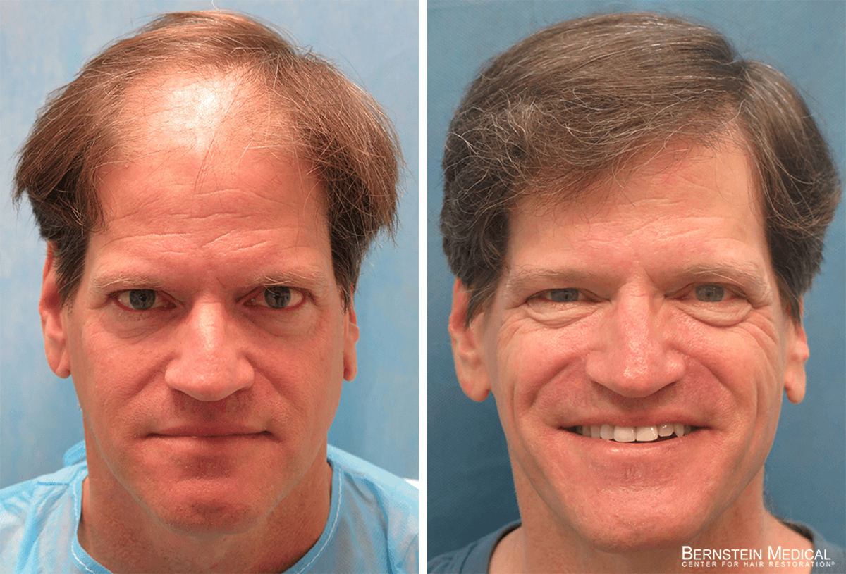 Bernstein Medical - Patient TRT Before and After Hair Transplant Photo 